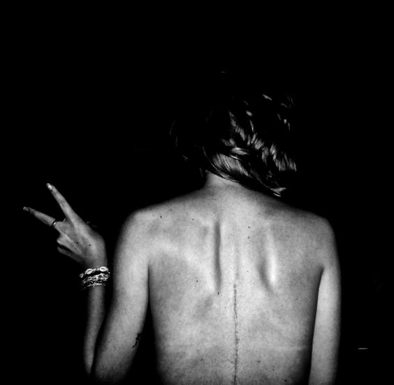 My Scoliosis surgery experience